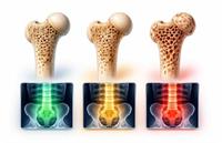 تفسیر سنجش تراکم استخوان