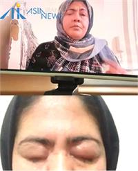 مرد افغان با اسید چشمان خواهر ۳۲ ساله‌اش را کور کرد