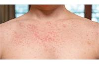 شدیدترین شیوع سرخک در اُنتاریو کانادا