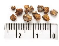 سنگهای سیستم ادراری