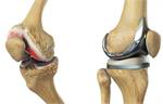 چه موقع به تعویض مفصل زانو نیاز پیدا میکنیم ؟