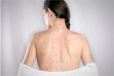 حذف کامل سرخک و سرخجه تا پایان ۲۰۲۳