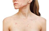 هشدار شیوع سرخک