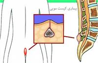 کیست مویی چیست و چه زمانی به پزشک مراجعه کنیم؟