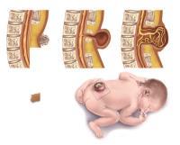 میلومننگوسل یا مننگوسل