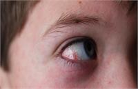 سرایت جدی سرخک در شهرهای ایران با عوارض کوری و عفونت مغز!