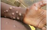 شدت یافتن توهم ابتلا به آبله میمون/شیوع بیماری مسری در ایران+تصویر