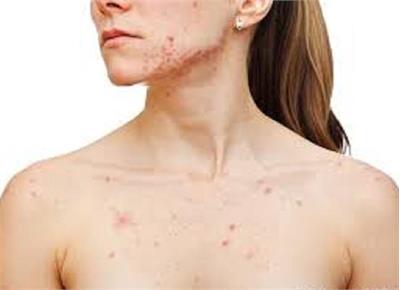 هشدار شیوع سرخک