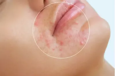 چرا بعد از لایه‌برداری پوست ممکن است جوش بزنیم؟